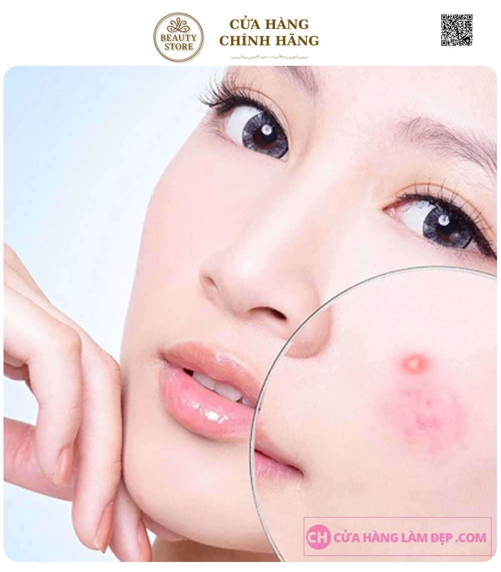 Liệu Trình Điều giảm Mụn Chuyên Sâu Bằng Công Nghệ Cao tại Meli Spa