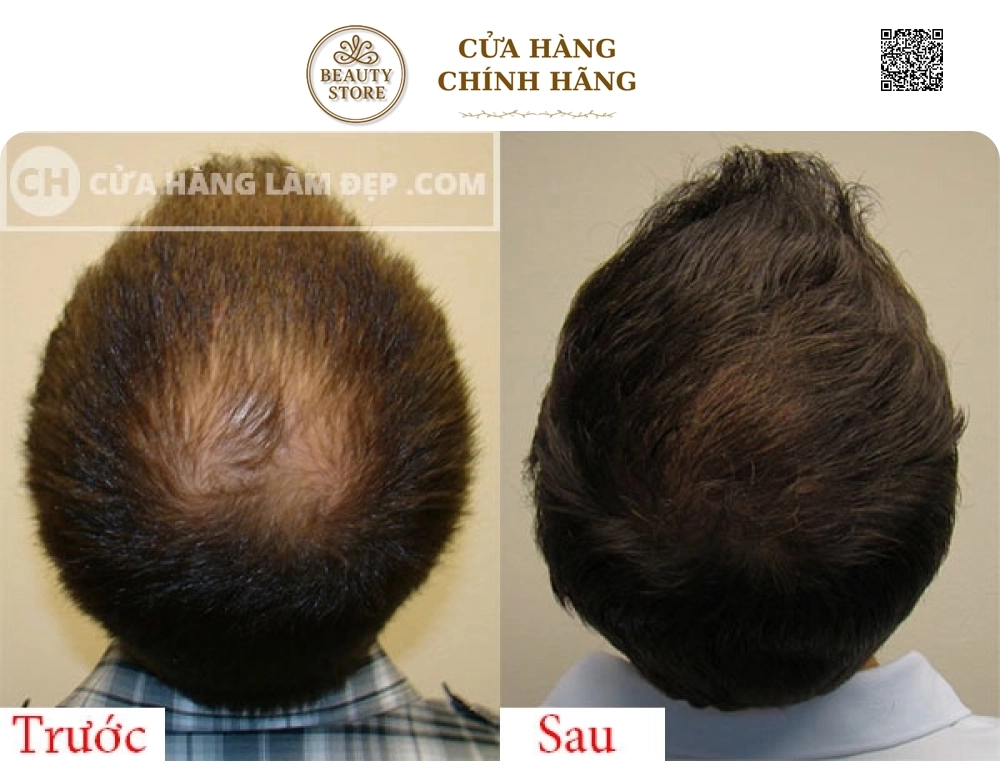 Tinh Chất Kích Thích Mọc Tóc Thảo Dược AROVICS Nhật Bản